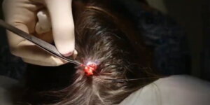 Pilar Cyst Removal
