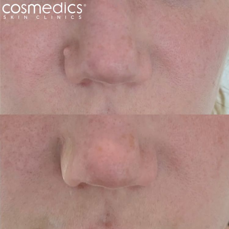 Mole removal laser and shave excision - nose