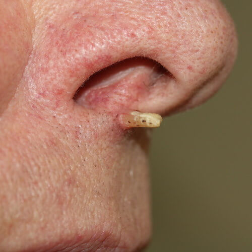 keratotic horn for excision removal