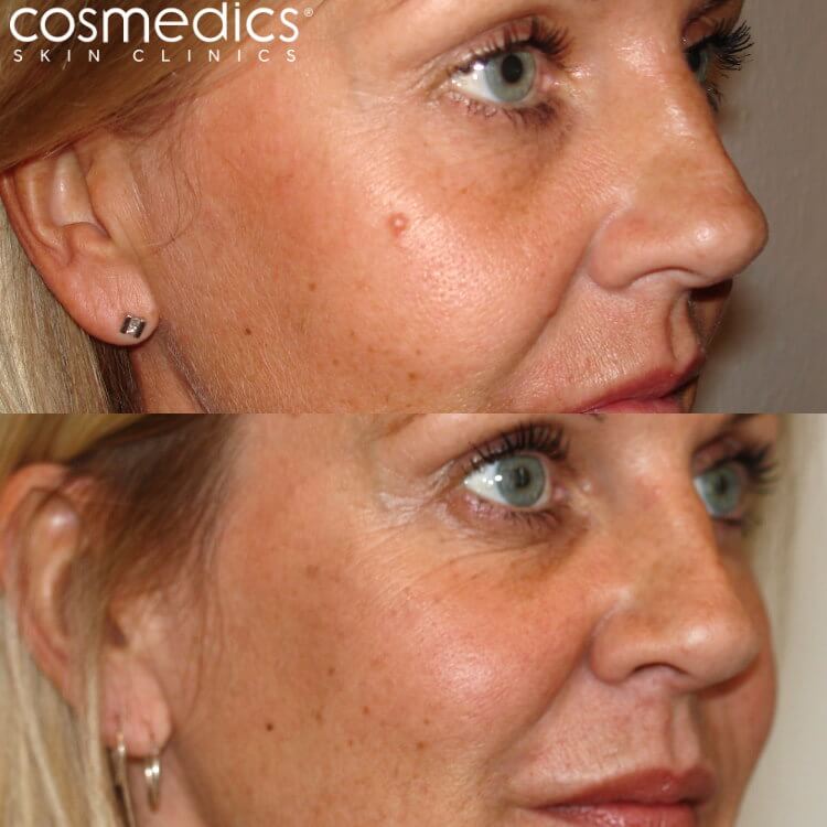 mole removal cheek results shave excision and laser