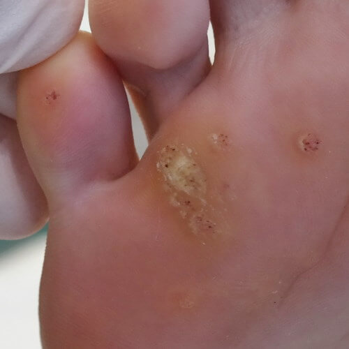 Verruca wart on soles of feet plantar warts