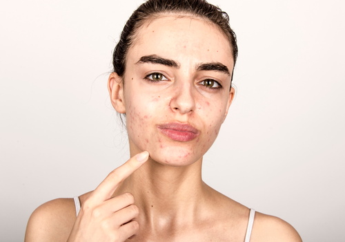 Acne Scarring